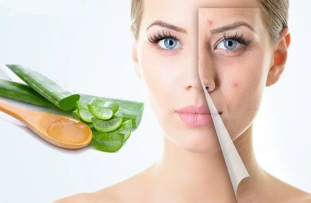 Mặt Nạ Nha Đam Trị Mụn: 5 Công Thức Đơn Giản, Hiệu Quả Từ Chuyên Gia